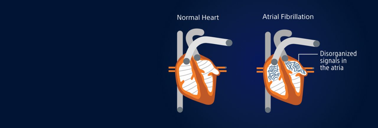 A graphic of two hearts visualization a normal heart and a heart that has atrial fibrillation.